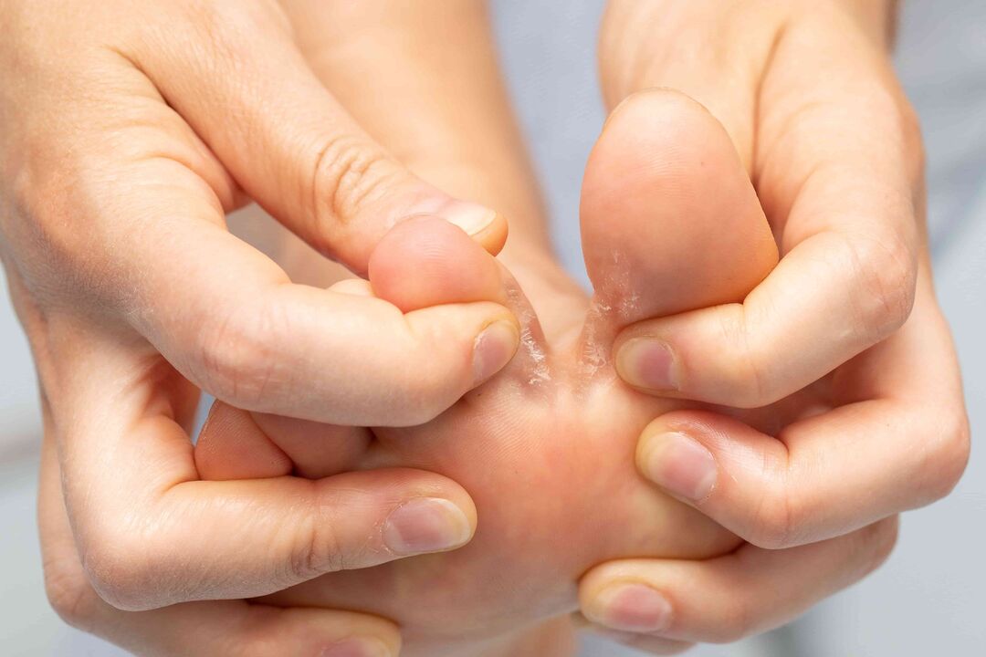 Mushrooms between toes and treatment with ZXCVNMQWERT