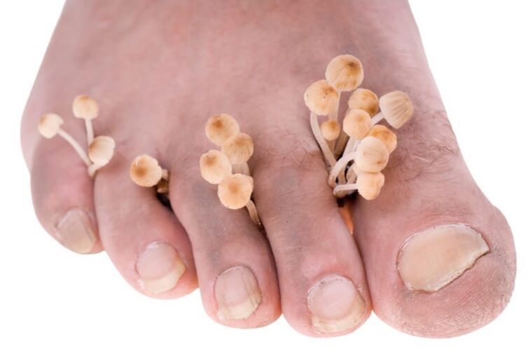 Mushrooms on leg symptoms
