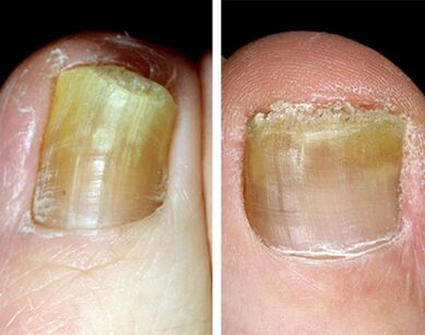 Far away shape of onychomycosis on legs