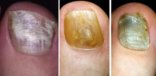 In the photo, the color change of nails on the feet with fungal disease