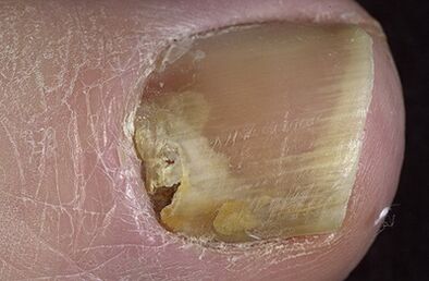 The combination of onychomycosis on the legs