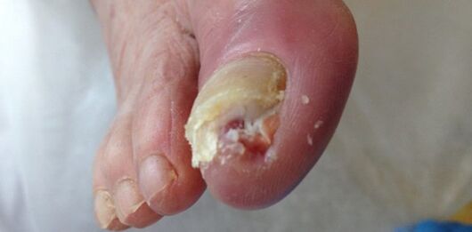 The reservoir and the source of dermatological fungal are a sick person