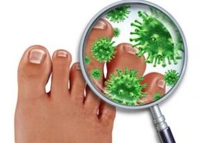 Methods of treating fungus on toenails