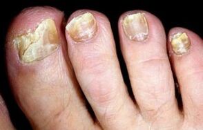 symptoms of toenail fungus